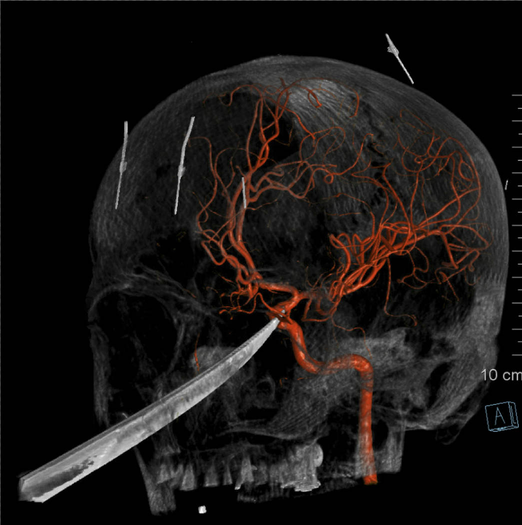 This 3D computer graphic model made from X-Ray imagery by The University of Kansas Health Syste ...