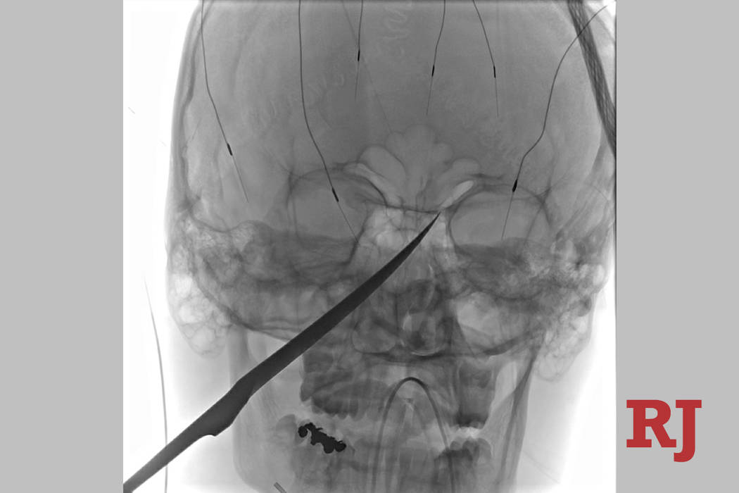 This X-Ray imagery provided by The University of Kansas Health System shows the skull of Eli Gr ...