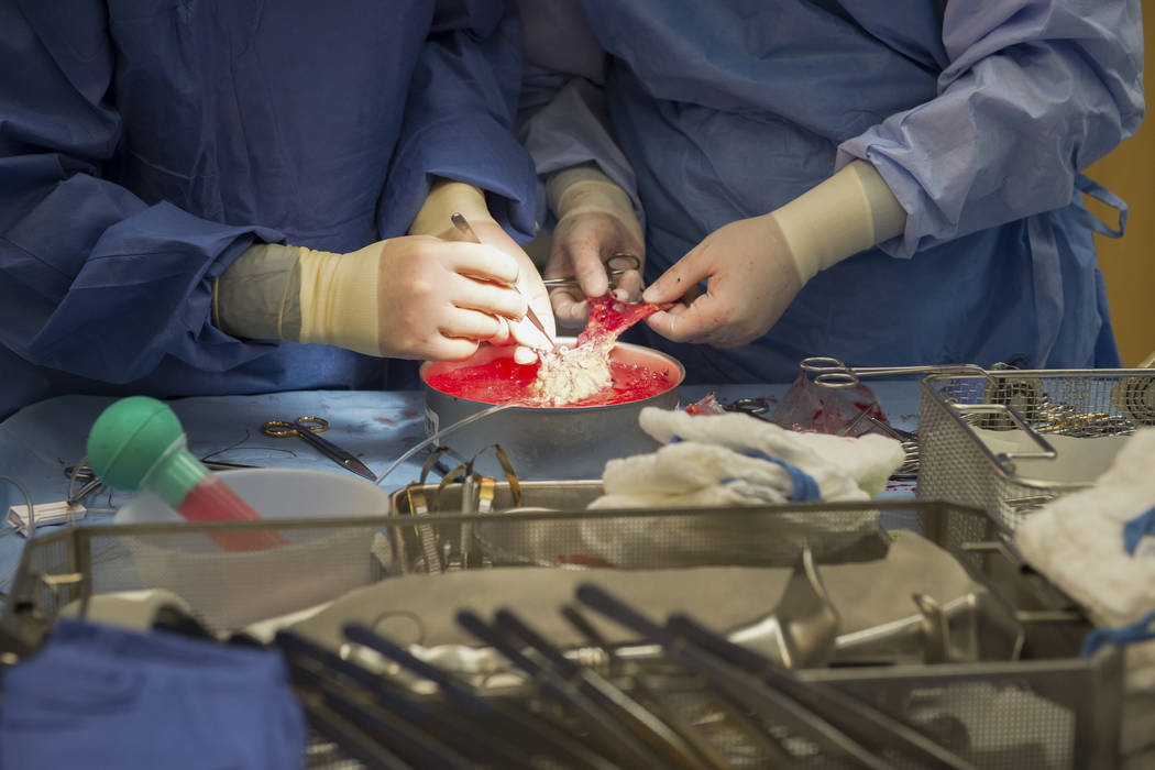 In a June 28, 2016, file photo, surgeons work on a kidney during a kidney transplant surgery at ...