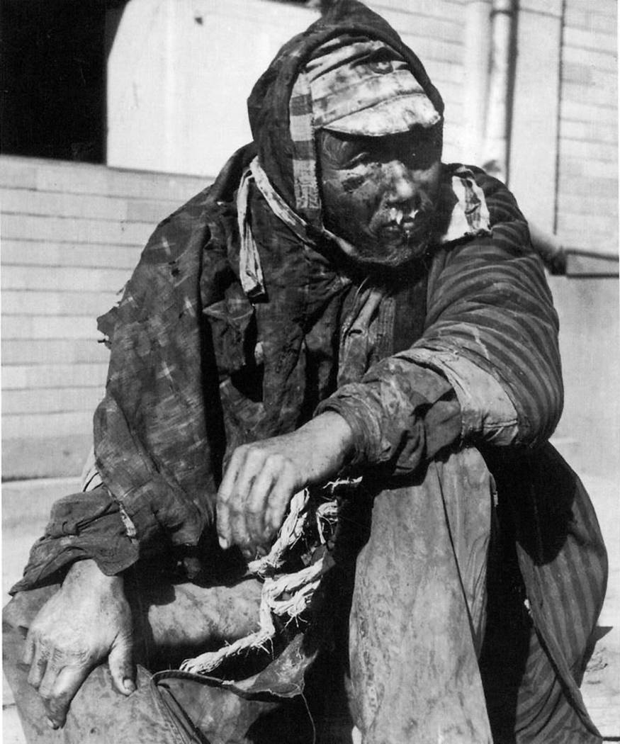 A badly burned Japanese man sits on the steps of a building that was turned into a hospital in ...