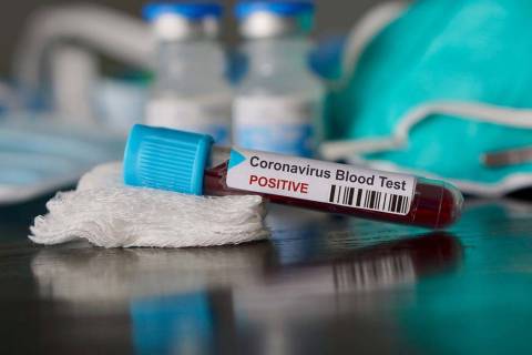 Positive blood test result for the new rapidly spreading Coronavirus, originating in Wuhan, Chi ...