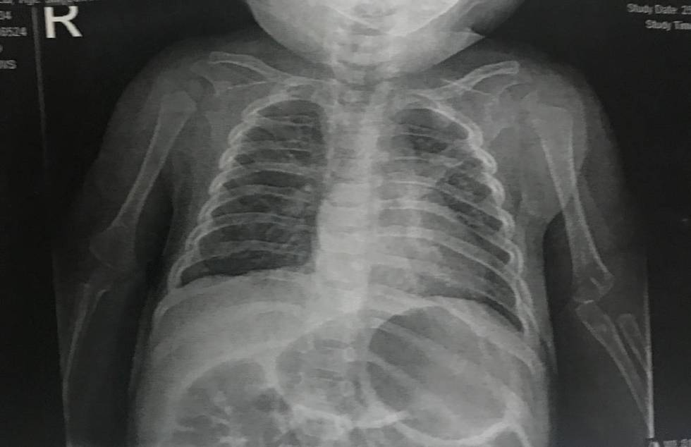 Caleb Anderson's chest X-ray, taken on Wednesday, March 25, 2020, at Summerlin Hospital Medical ...