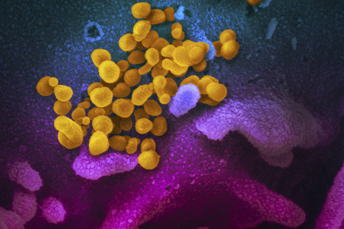 The novel coronavirus SARS-CoV-2, yellow, emerges from the surface of cells, blue/pink, culture ...