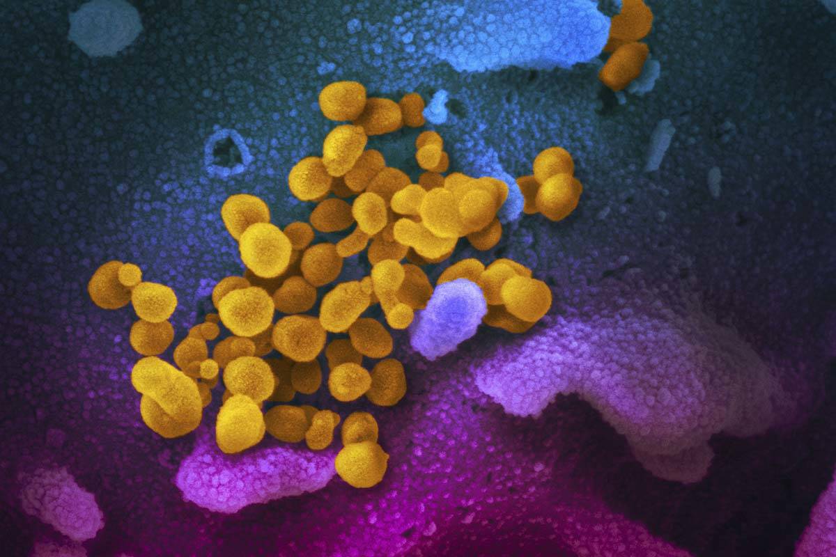 Novel Coronavirus SARS-CoV-2, yellow, emerging from the surface of cells, blue/pink, cultured i ...