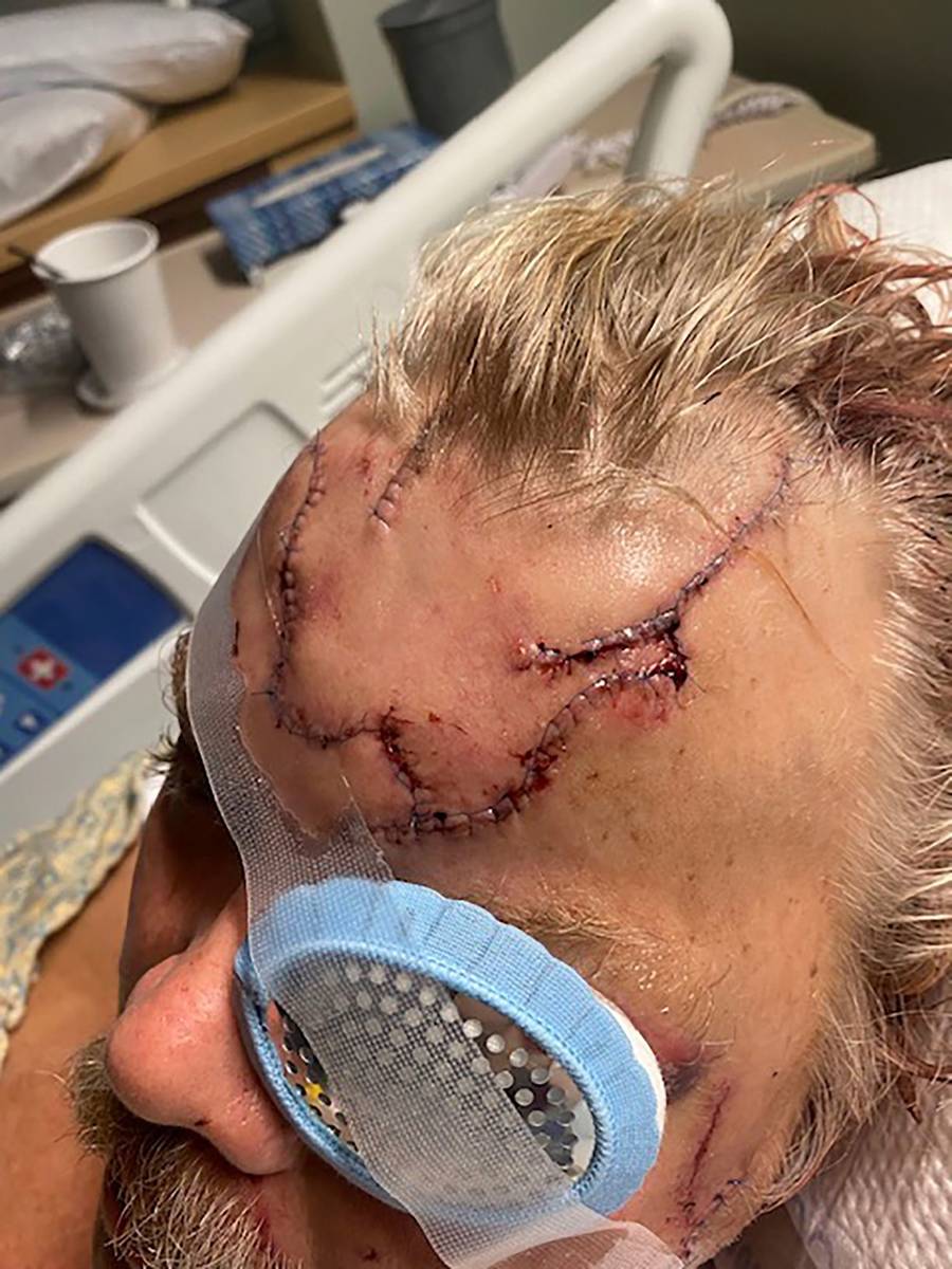 Lacerations are seen on Allen Minish's head as he recuperates at a hospital in Anchorage, Alask ...