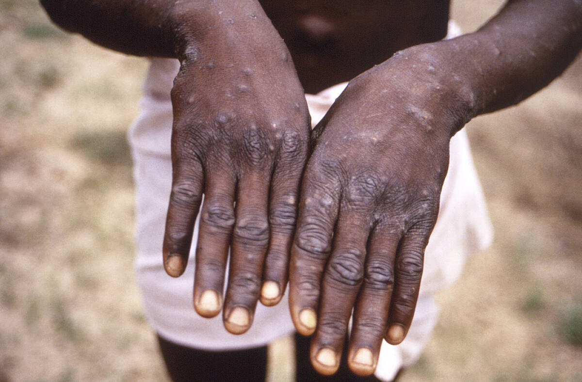 This 1997 image provided by the CDC during an investigation into an outbreak of monkeypox, whi ...