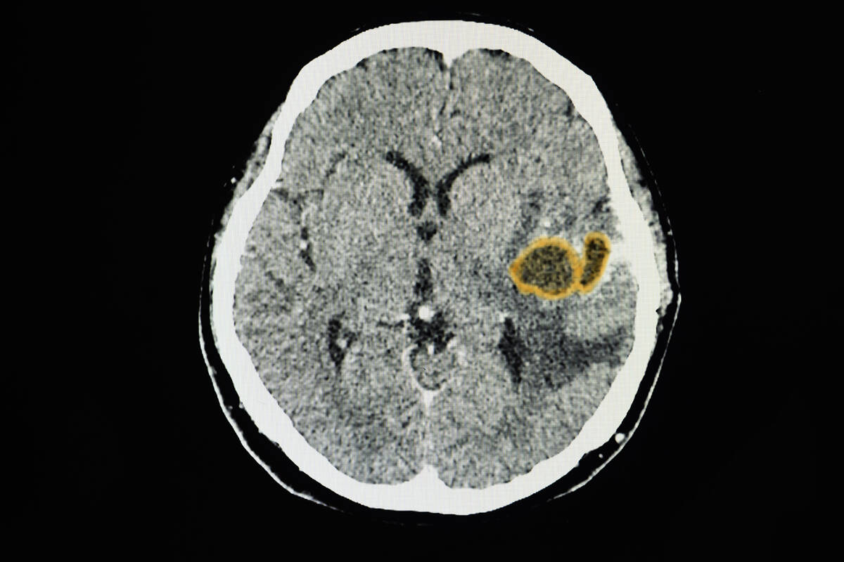 A CT brain scan of a patient with large brain abscesses in her left temporal lobe.(Getty Images)