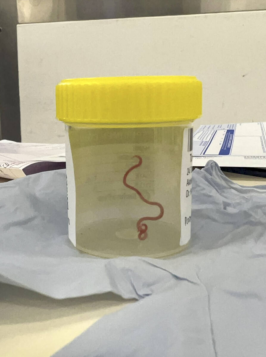 This undated photo supplied by Canberra Health Services, shows a parasite in a specimen jar at ...