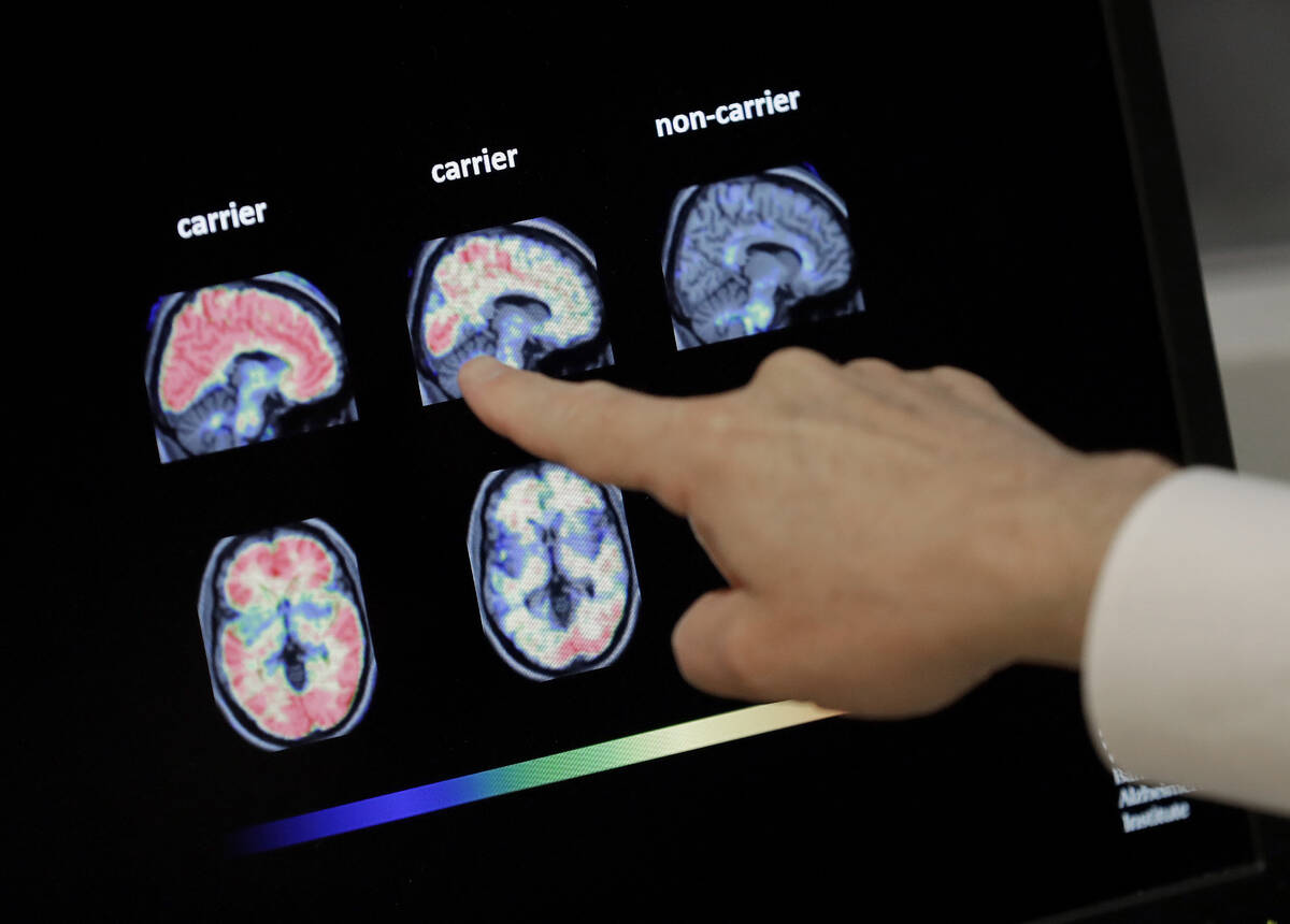 A doctor looks at PET brain scans at Banner Alzheimers Institute in Phoenix on Aug. 14, 2018. ( ...