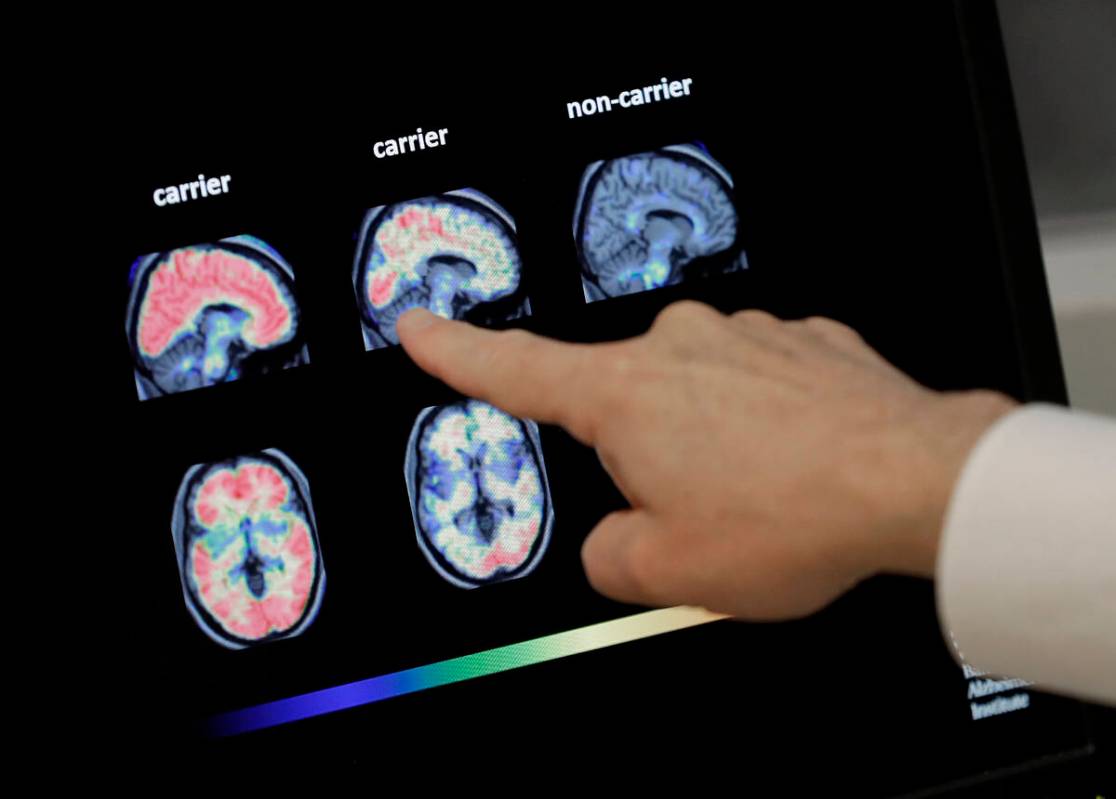 A doctor looks at PET brain scans at Banner Alzheimers Institute in Phoenix on Aug. 14, 2018. ( ...